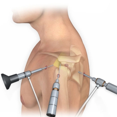 Shoulder arthroscopy treatment for shoulder pain and injuries
