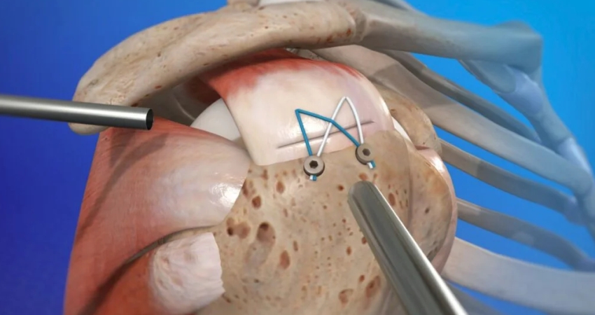 Arthroscopic shoulder surgery in Faridabad