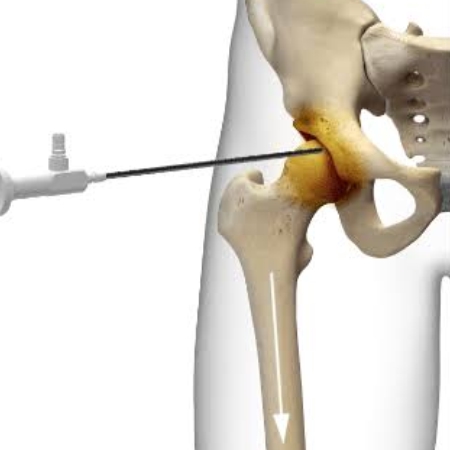 Hip arthroscopy for labral tear and hip impingement