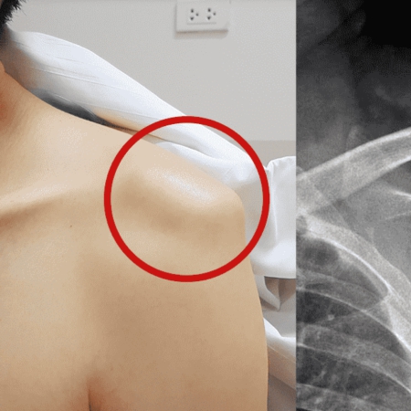 Shoulder Dislocation Treatment in Faridabad