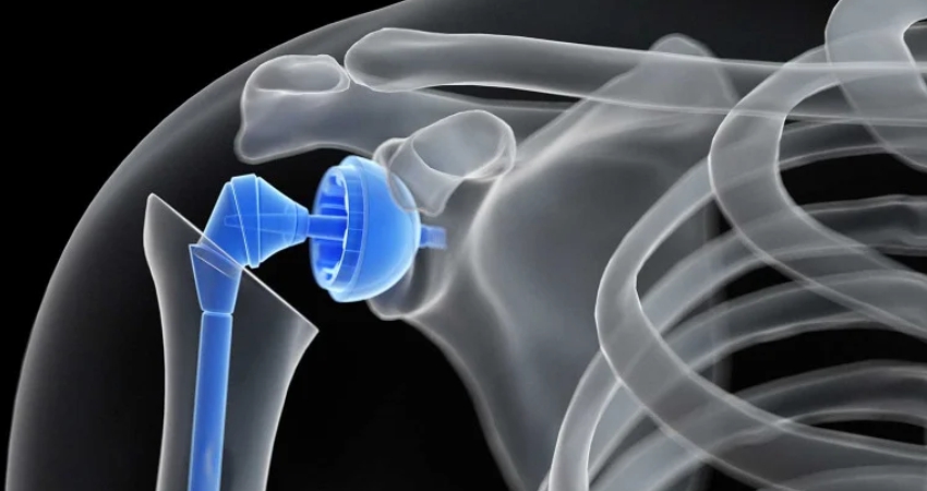 Shoulder replacement including reverse shoulder in Faridabad