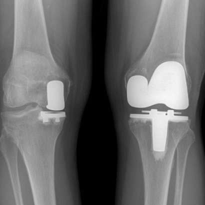 Knee arthritis evaluation for replacement surgery